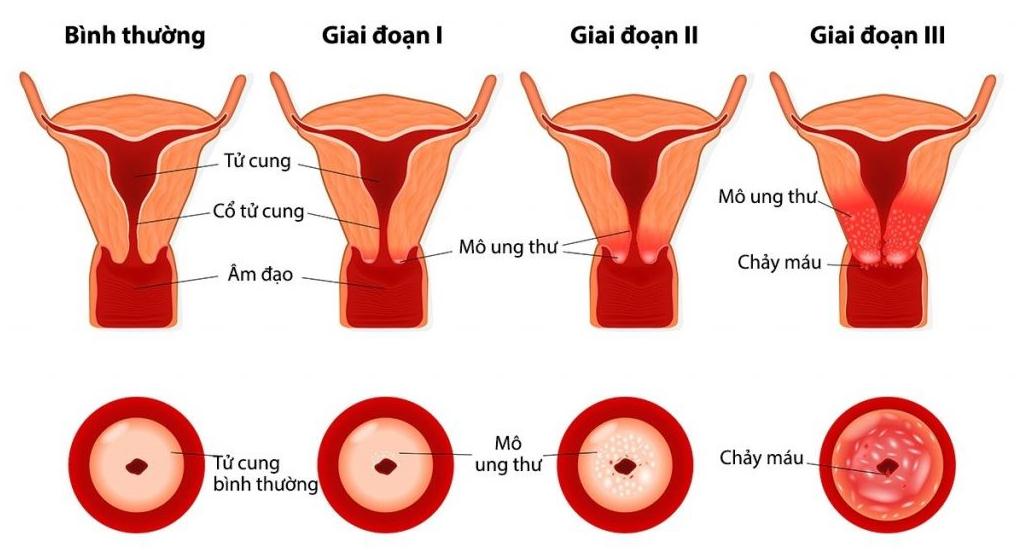 Ung thư cổ tử cung