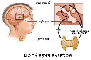 bệnh basedow bệnh học