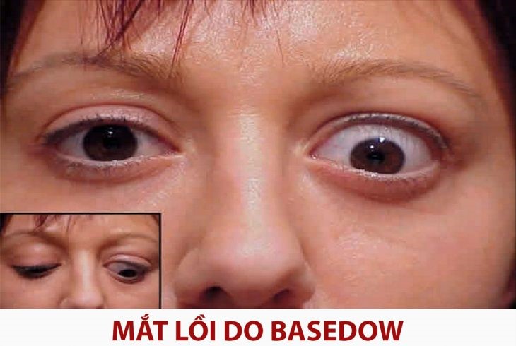 Cách điều trị bệnh bướu cổ Basedow