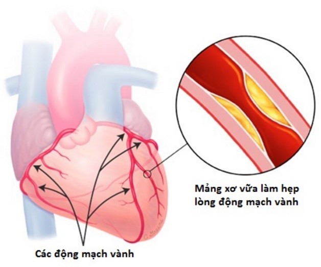 Tình trạng bệnh 3 nhánh mạch vành là gì?