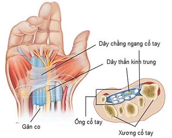 Đứt dây thần kinh cổ tay