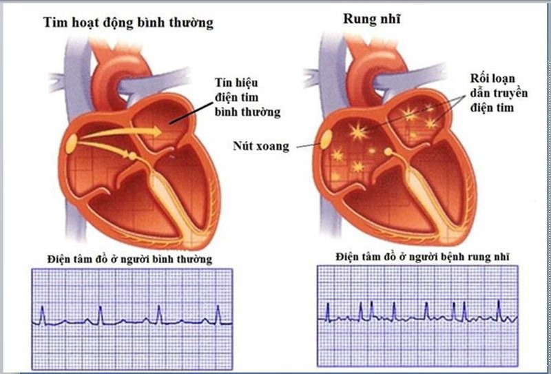 rung nhĩ tiếng anh là gì