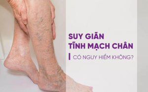 Suy giãn tĩnh mạch chân