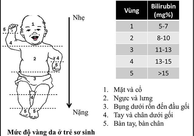 đánh giá mức độ vàng da 