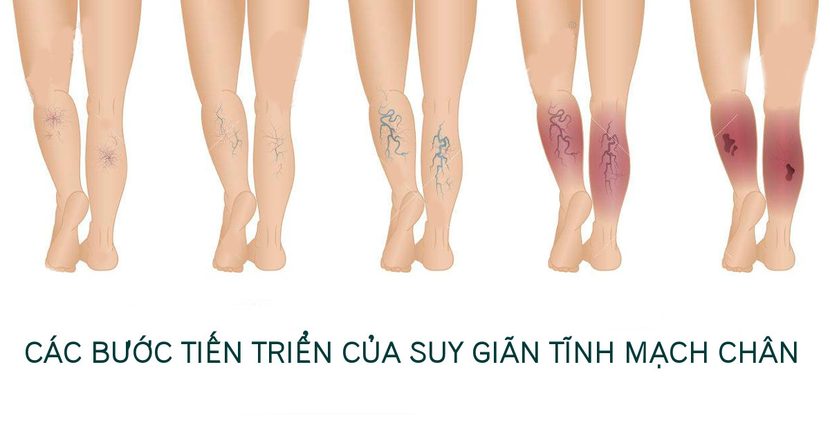 giãn tĩnh mạch gót chân