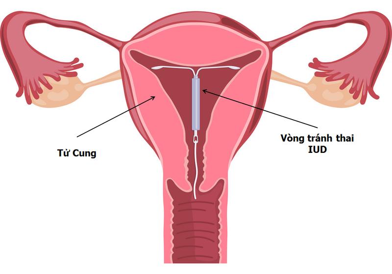 vô kinh có con được không