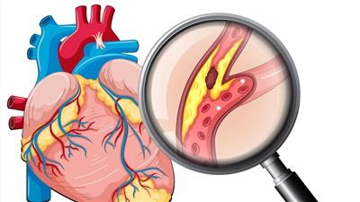 xét nghiệm Hs - Troponin